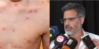 Brote de varicela en Entre Ríos: confirmaron 700 casos y la mayoría son adolescentes