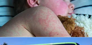 Solicitan a quienes viajaron en ómnibus por Entre Ríos estar atentos ante posible exposición al sarampión